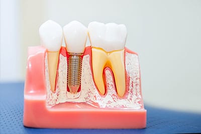 dental implants leesburg