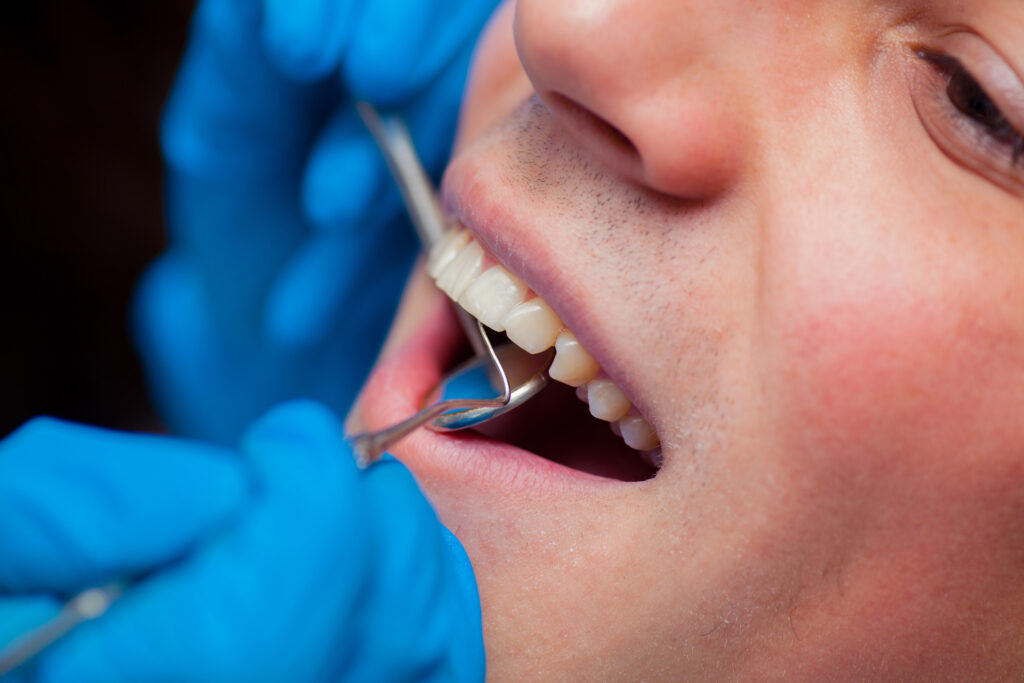 Chipped Tooth