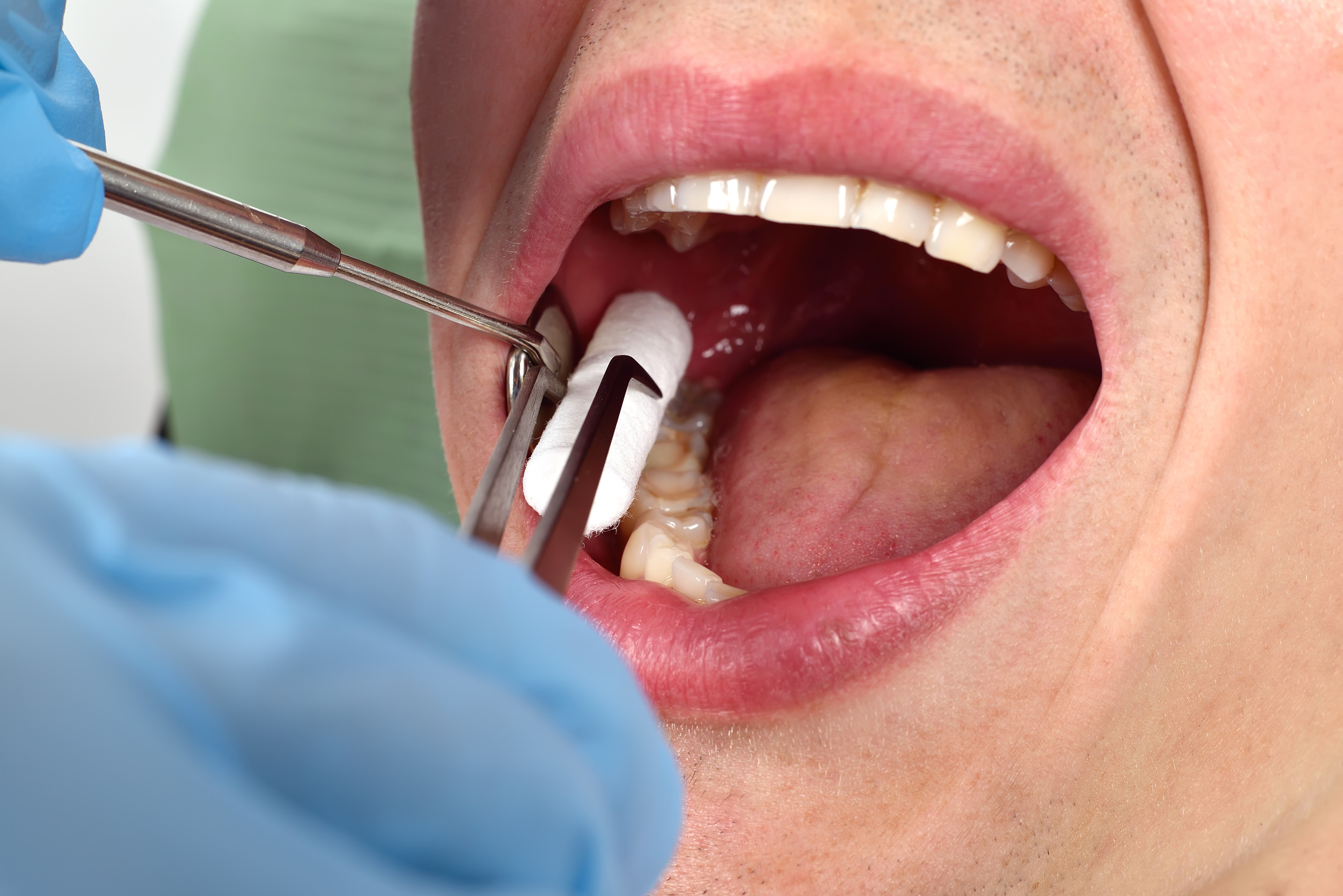 cracked tooth fixed by Leesburg dentist